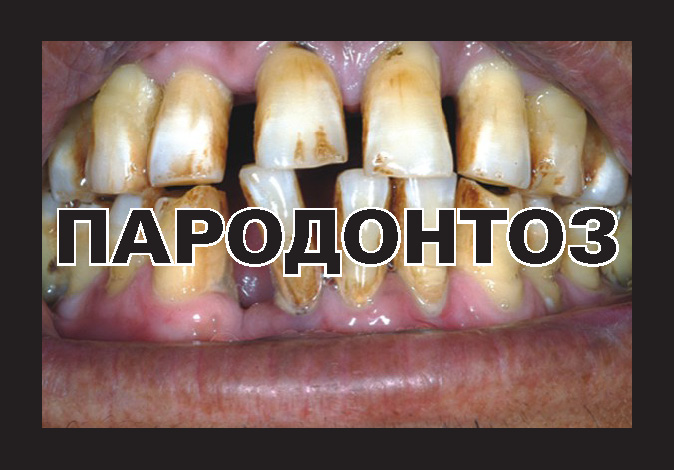 Russia 2013 Health Effect mouth -diseased teeth, gross
